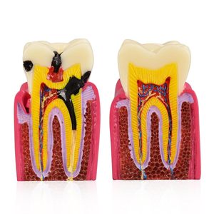 Modèle de démonstration de caries dentaires, modèle d'enseignement de l'anatomie dentaire pour l'éducation et l'explication aux patients - Product Image 2