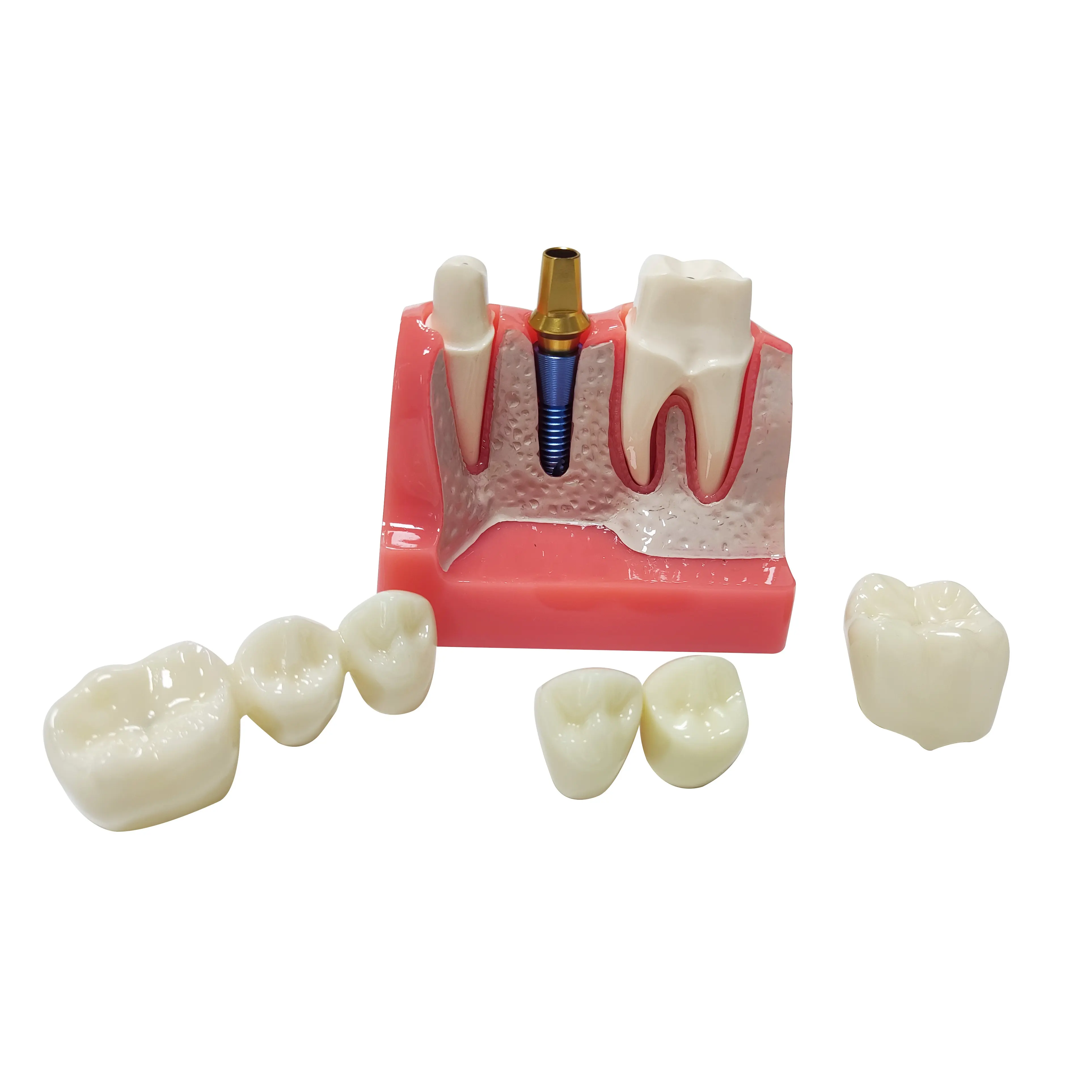 Modelo de demonstração de boca para odontologia, modelo de dentes, análise de doenças com restauração e ponte coroa, mandibular maxilar