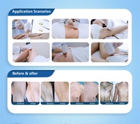 ADSS Android 4 longueurs d'onde 755 808 940 1064 Ice Diode Laser Beauty, machine d'épilation au laser diode indolore pour tous les tons de peau