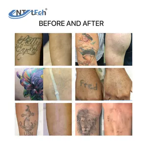 Novo modelo de máquina de remoção de tatuagem a laser com comutação q, nd yag, picossegundos, para remoção de tatuagem de verruga e sardas