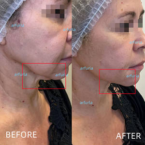 Fibra Endolaser para lipólise Cut Soft Tecido Bodylift Fibra Óptica SMA905 - Product Image 5