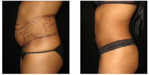 Factory <strong>Price</strong> 1470nm 980nm Diode Laser Equipment Laser Face Lifting <strong>Lipolysis</strong> Laser Liposuction <strong>Machine</strong> - Product Image 6