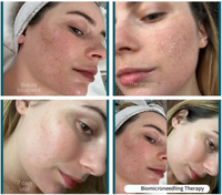 Thérapie de micro-aiguilletage bio aux spicules de Spongilla, élimination de l'acné, peeling aux algues, resserrement de la peau, masque en poudre peel-off aux algues naturelles