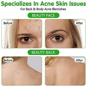 สเปรย์กรดไฮโปคลอไรซ์ ช่วยรักษาสิว ผื่นคัน และผื่นแพ้ ผสมกรดซาลิไซลิก 2% และน้ำมันทีทรี สเปรย์กำจัดสิว - Product Image 4