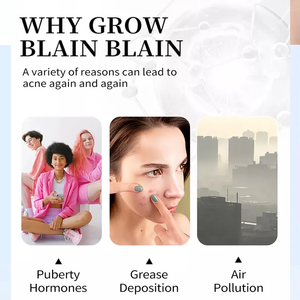 Crème réparatrice anti-acné professionnelle OEM 50g, crème <span class=keywords><strong>de</strong></span> soin <span class=keywords><strong>de</strong></span> la <span class=keywords><strong>peau</strong></span> pour peaux sujettes à l'acné, crème intensive pour peaux à tendance acnéique - Product Image 4