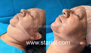 2025 Newset Professionnel 980nm Diode Laser Endolaser Machine Lipolyse Rouge Sang Araignée Veine Enlèvement Vasculaire - Product Image 2