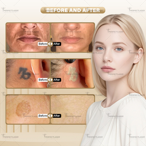 Perfectlaser 532nm 1064nm <span class=keywords><strong>Laser</strong></span> loại bỏ hình xăm tóc loại bỏ vẻ đẹp thiết bị chuyên nghiệp Q chuyển đổi <span class=keywords><strong>Laser</strong></span> loại bỏ hình xăm máy - Product Image 6