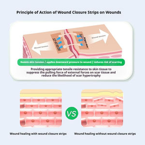 מתח רפואי-הפחתת רוכסן נטול תפרי-סוג צלקת עור ללא רוכסן עבור פצעי ניתוח בלוטת התריס - Product Image 2