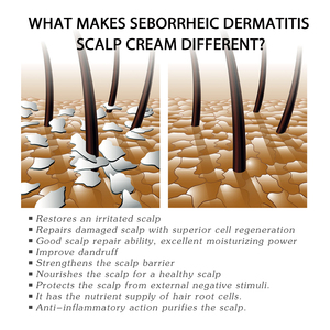 Crème de soin du <span class=keywords><strong>cuir</strong></span> <span class=keywords><strong>chevelu</strong></span> South Moon, crème nettoyante, hydratante et réparatrice pour le <span class=keywords><strong>cuir</strong></span> <span class=keywords><strong>chevelu</strong></span>, soulagement de l'eczéma et des démangeaisons, soin topique - Product Image 5