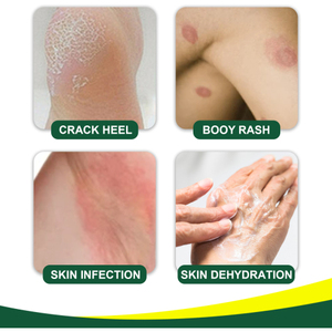 Crème à base de plantes South Moon Tinea Corproris pommade externe douce et non irritante pour soulager <span class=keywords><strong>les</strong></span> démangeaisons du corps - Product Image 2