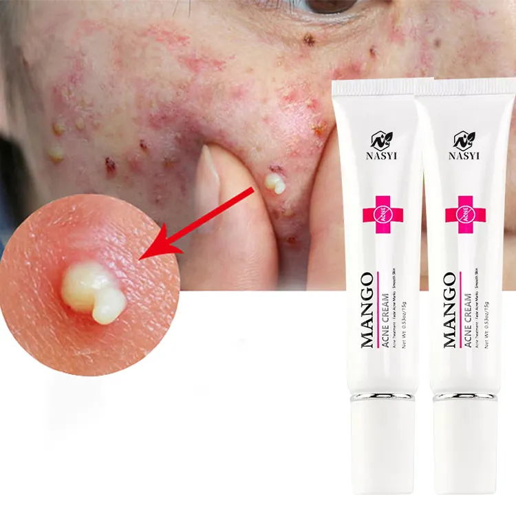 Schnelle effektive Gesichts pflege Anti-Flecken Mango-Reparatur Entfernung Akne-Creme Glatte Haut Schrumpfen Poren Narbe Mitesser Akne-Behandlungs creme