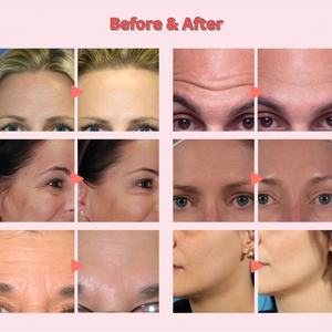 Máquina de Hidrodermoabrasión Aquafacial H2o2, Máquina Facial de Oxígeno, Máquina de Oxígeno Médico - Product Image 4