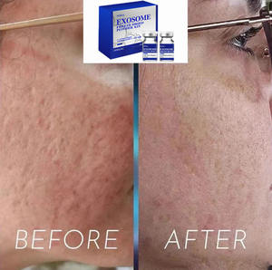 Ab Werk OEM Exos Gefriergetrocknetes Pulver Korea Hautpflege-Set Exos Hautverbesserer Gegen Falten und Akne Y - Product Image 6