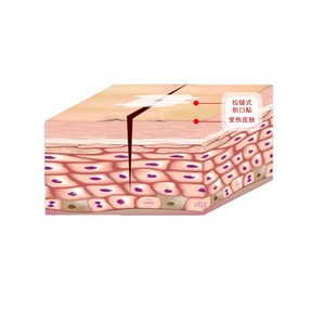 ผ้าพันแผลยืดหยุ่น L2-6 5 สำหรับการปิดแผลหลังการผ่าตัด - Product Image 3