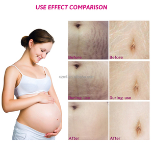 Crema Reparadora de Estrías de Marca Privada para el Cuidado de la Piel, Eliminación de Cicatrices del Embarazo, Crema Natural de Manteca de Karité para el Abdomen - Product Image 5