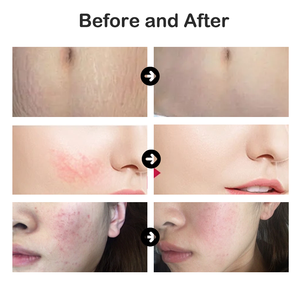 R Portable Co2 Fractional <strong>Laser</strong> <strong>Machine</strong> for Skin Resurfacing Acne Scar Stretch Marks Removal <strong>Laser</strong> Engraving <strong>Machine</strong> Co2 - Product Image 2