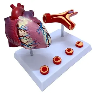 Modelo de injerto de derivación arterial para el corazón, modelo de injerto de derivación de la coronaria para la enfermedad cardíaca, se atascan y se forman obstrucciones en los vasos