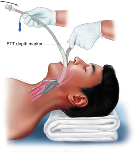 نوع معزز بالهواء الطبي القابل للتصرف مع شهادة CE و ISO بجودة لطيفة وسعر جيد - Product Image 4