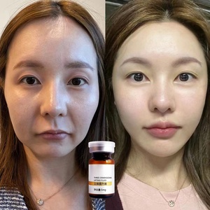 Produit d'usine OEM pour peau relâchée : Ampoule <span class=keywords><strong>V</strong></span>-<span class=keywords><strong>Line</strong></span> pour éliminer le double menton, réduire les poches du visage, lifting instantané et raffermissant du visage en <span class=keywords><strong>V</strong></span>. - Product Image 6