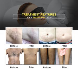 Nouvel appareil d'épilation au <span class=keywords><strong>laser</strong></span> diode portable 808 nm pour femmes, équipement de spa médical, vente en gros - Product Image 4