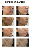 Produit Tendance 2026 Double longueur d'onde 1927+1550nm Thulium Fractionnel Erbium Glass Non Ablatif Thulium Resserrement Cutané Lifting Facial