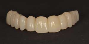 Denti Artificiali <span class=keywords><strong>in</strong></span> Resina Personalizzati con Alimentazione Elettrica per Tutti dai Laboratori Dentali Cinesi - Product Image 2