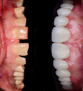 43% 57% di traslucenza 700-1200 MPa resistenza alla flessione YUCERA dentale 98mm sistema aperto CAD/CAM 4D Pro blocco di zirconio multistrato - Product Image 5