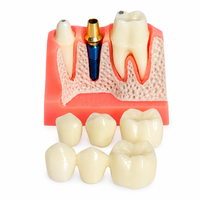 Modèle d'implant dentaire pédagogique, modèle détachable de couronne dentaire et de visqueuse pour la formation des dentistes et l'affichage en clinique