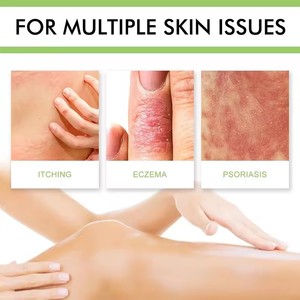 Produttore all'ingrosso 30g crema topica per <span class=keywords><strong>Eczema</strong></span> e psoriasi unguento prurito fornitura sanitaria - Product Image 2