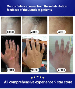 Knel KN4003 Photothérapie à lampe unique UVB cliniquement prouvée pour le traitement du psoriasis d'autres maladies immunitaires de la peau - Product Image 5