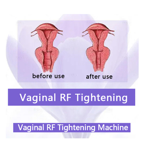 Sản phẩm bán chạy: Thiết bị y tế đa chức năng chăm sóc phụ khoa, rửa âm đạo bằng ozone, làm se khít âm đạo - Product Image 3
