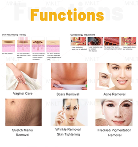 Chuyên Nghiệp Mặt Máy Phân Đoạn Âm Đạo Thắt Chặt Phần Đánh Dấu Fotona Cho Bút Sợi Đánh Dấu CO2 Laser - Product Image 6