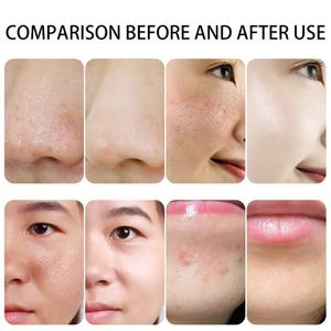 Máquina de Belleza Facial Portátil 6 en 1 con Hidrógeno y Oxígeno, Visibilidad 360°, con Pulverizador de Agua Oxigenada Nano para una Piel Clara - Product Image 5