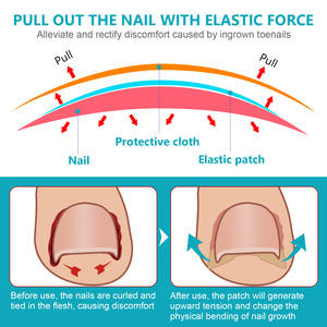 Parches para el Tratamiento de Uñas Encarnadas SEFUDUN al por Mayor, Kit de 120 Tiras Correctoras para Uñas Encarnadas con Lima y Levantador - Product Image 4
