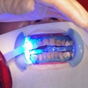 Masque facial dentaire en gaze pour soins bucco-dentaires et blanchiment des dents avec protection des lèvres - Product Image 4