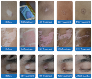 Lampu Terapi Sinar Matahari Terlaris untuk Depresi, Fototerapi UVB 308nm Sistem Excimer untuk Pengobatan Psoriasis dan Vitiligo - Product Image 3