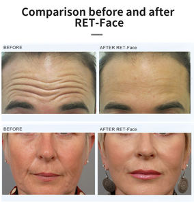 Máquina de Rejuvenecimiento Facial <span class=keywords><strong>RET</strong></span> RF No Invasiva y Segura, Moldeadora de Línea <span class=keywords><strong>V</strong></span> sin Dolor, Reafirmante de Piel, Equipo de Belleza Antienvejecimiento para Salón - Product Image 5