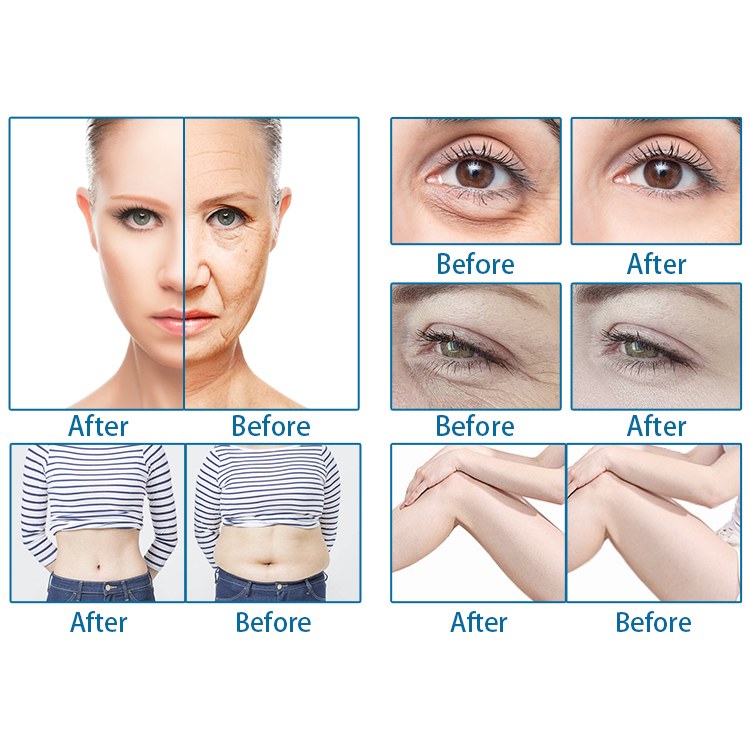 2022 New Technology MMFU 3D 4D 6D 7D HIFU Former 12 Lines 20000shots Machine Face Lifting Anti-wrinkle Microneedle RF