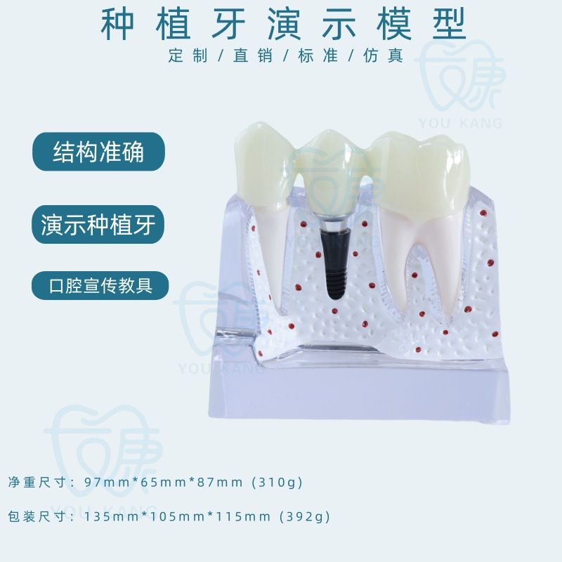 Implante dental C, uña negra transparente.