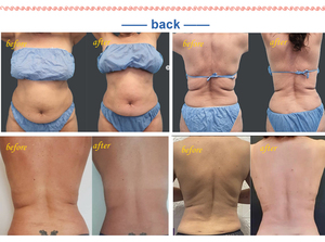 2024 Triangel TR-B endolaser diodo 980nm 1470nm lipolysis mặt nâng <span class=keywords><strong>Laser</strong></span> endolaser máy - Product Image 6