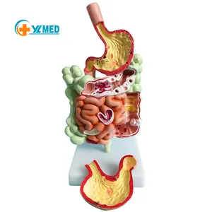 Teaching simulation pathological large intestine model gastrointestinal lesions large intestine anatomical model