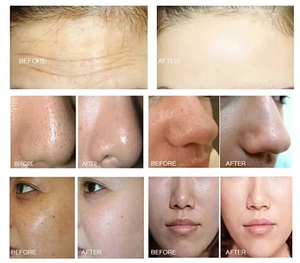 Analyseur de peau 7-en-1 <span class=keywords><strong>Hyd</strong></span> Oxygen 2026, Soin du visage Aqua Peeling, Dermabrasion au diamant, Éliminateur de points noirs, Machine de nettoyage Aqua Peeling - Product Image 6