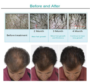 Scalp Care <b>Machine</b> for Hair Clinic Spa Salon 5in1 Anti Hair Loss Scalp Analysis Treatment Hair Growth Therapy <b>Machine</b> <b>Massage</b> - Product Image 5