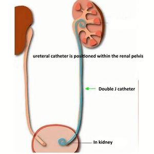 Veteriner Kullanımlık Çift <span class=keywords><strong>J</strong></span> Üreteral Pigtail Drenaj Kateteri <span class=keywords><strong>Stent</strong></span> Üroloji Tıbbi Cihazı EOS İntravasküler <span class=keywords><strong>J</strong></span> <span class=keywords><strong>Stent</strong></span> - Product Image 2