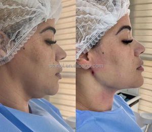 Máquina de Lifting Endoláser de Doble Longitud de Onda 980nm 1470nm para Lifting Facial y Lipólisis, Aprobada por UKCA y con Declaración de Conformidad CE - Product Image 6