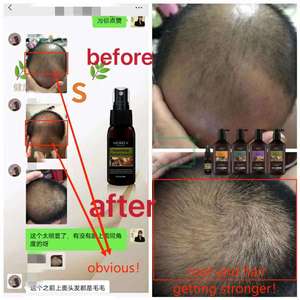 Nuevo Sérum Capilar Natural de Jengibre para el Crecimiento Rápido del Cabello, Spray para el Cuero Cabelludo, Tratamiento para la Caída del Cabello, Detiene la Pérdida de Cabello, con Biotina para Hombre y Mujer - Product Image 3