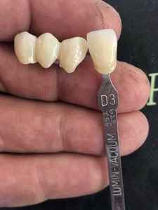 Blocchi di Zirconia Multistrato 3D Plus YUCERA Avanzati per Risultati Dentali Estetici Ottimali - Product Image 6