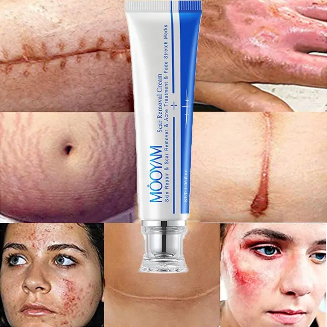 Wholesale Acne Pimples Stretch Marks Scar Removing,Scar Removal Cream for Old Scars On Face And Legs,Body Scar Removal Cream