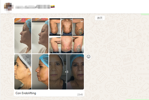 Láser de Diodo Endolifting 980nm 1470nm para <span class=keywords><strong>Disolver</strong></span> Grasa, Lifting Facial y Reafirmación de la Piel, Uso Médico en Spa - Product Image 2