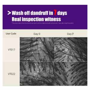 Gel nettoyant professionnel pour le <span class=keywords><strong>cuir</strong></span> <span class=keywords><strong>chevelu</strong></span>, anti-pelliculaire, détoxifiant, rafraîchissant, anti-démangeaisons, réparateur du <span class=keywords><strong>cuir</strong></span> <span class=keywords><strong>chevelu</strong></span>, pour le <span class=keywords><strong>psoriasis</strong></span>, à utiliser avant le <span class=keywords><strong>shampoing</strong></span> - Product Image 4